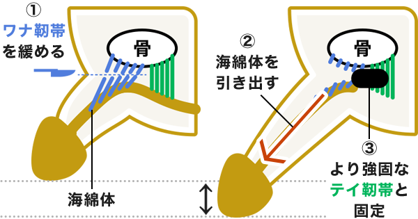 長径術について