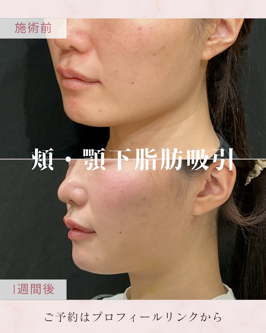 脂肪吸引：カニューレと呼ばれる細い管を使用して皮下脂肪を吸引・除去し、ボディラインやフェイスラインを整える施術です。脂肪細胞そのものを減らすことで、部分的なサイズダウンやすっきりとした輪郭を目指します。の症例写真