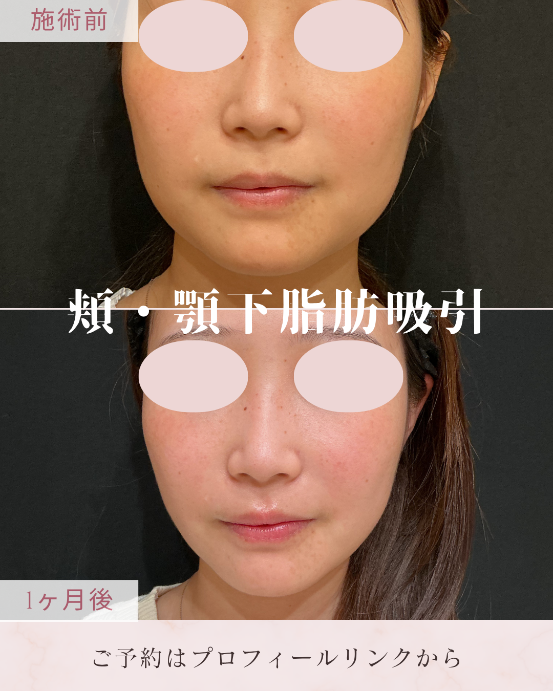 脂肪吸引：カニューレと呼ばれる細い管を使用して皮下脂肪を吸引・除去し、ボディラインやフェイスラインを整える施術です。脂肪細胞そのものを減らすことで、部分的なサイズダウンやすっきりとした輪郭を目指します。の症例写真