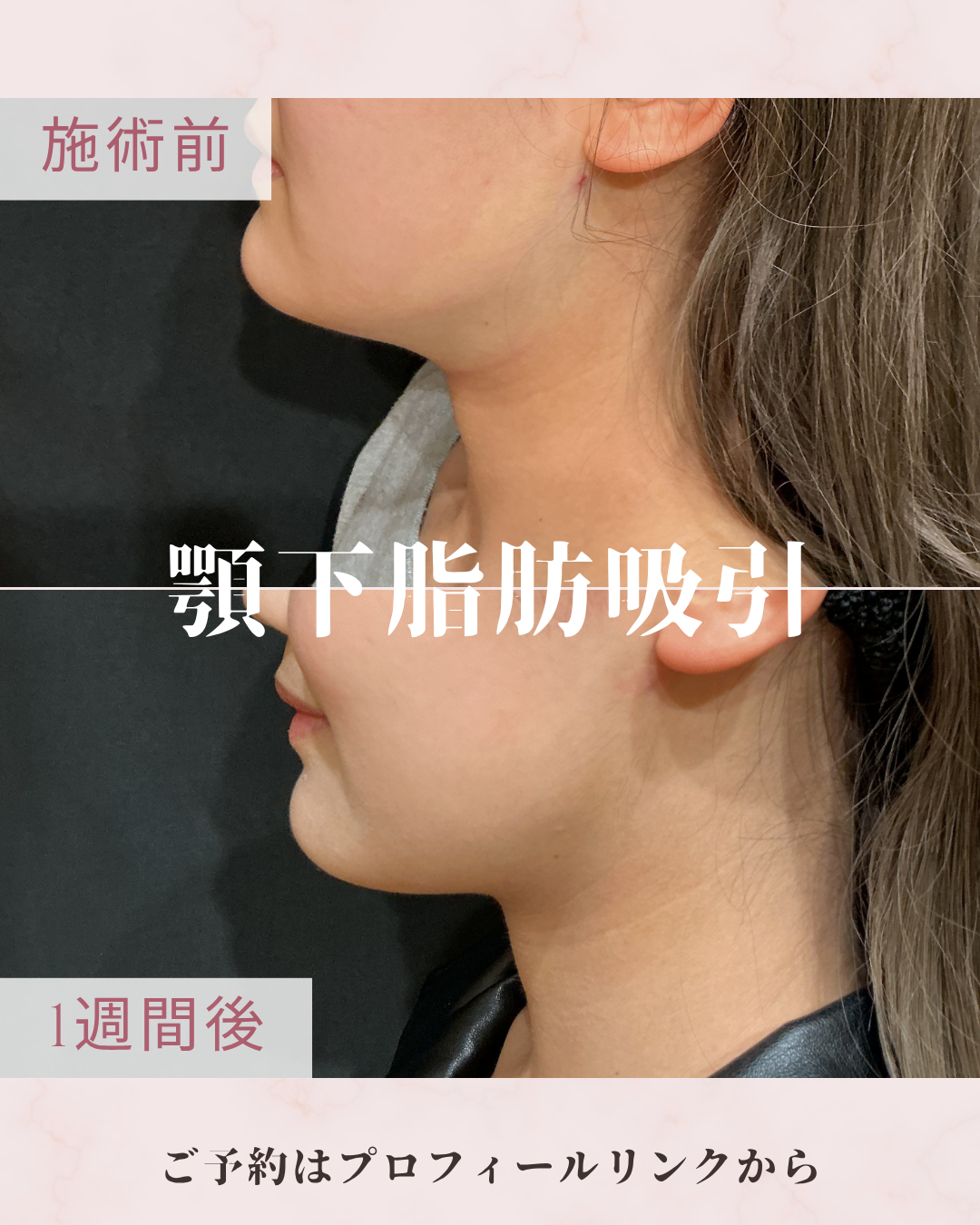 脂肪吸引：カニューレと呼ばれる細い管を使用して皮下脂肪を吸引・除去し、ボディラインやフェイスラインを整える施術です。脂肪細胞そのものを減らすことで、部分的なサイズダウンやすっきりとした輪郭を目指します。の症例写真