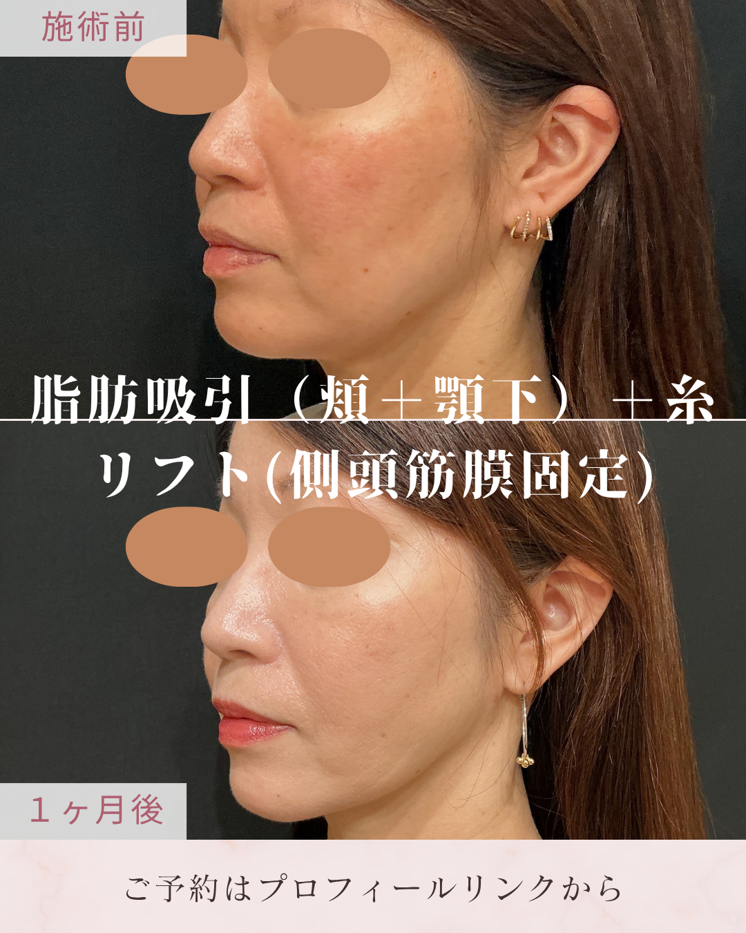 脂肪吸引：カニューレと呼ばれる細い管を使用して皮下脂肪を吸引・除去し、ボディラインやフェイスラインを整える施術です。糸リフト（PDO・PCL）：医療用の吸収性糸を皮下に挿入し、たるみを引き上げてフェイスラインを整える施術です。の症例写真