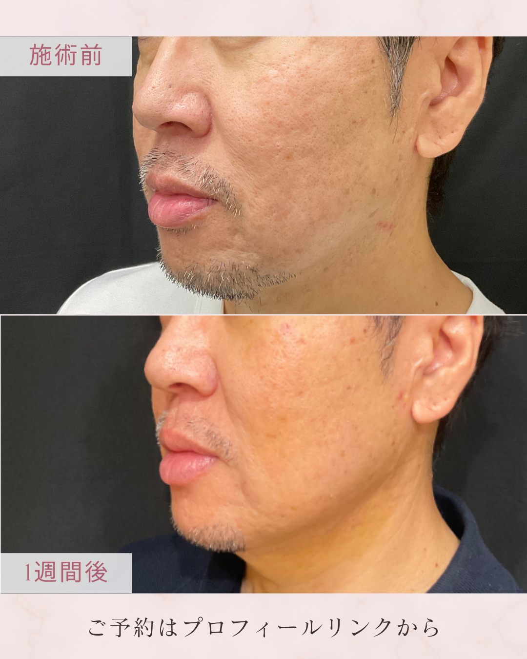 脂肪吸引：カニューレと呼ばれる細い管を使用して皮下脂肪を吸引・除去し、ボディラインやフェイスラインを整える施術です。脂肪細胞そのものを減らすことで、部分的なサイズダウンやすっきりとした輪郭を目指します。の症例写真