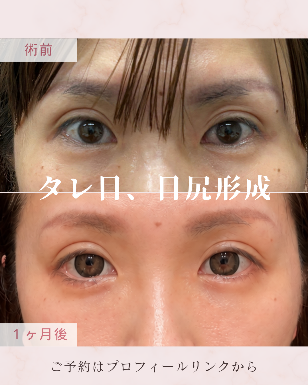 タレ目形成・目尻切開：目尻切開は目尻側を切開して横方向への目の広がりをつくり、目元を大きく見せる施術です。W形成やリドレープ法などを選択します。グラマラスライン形成は下まぶたのラインを下方向に調整し、やわらかく優しい印象のタレ目を形成する施術です。の症例写真