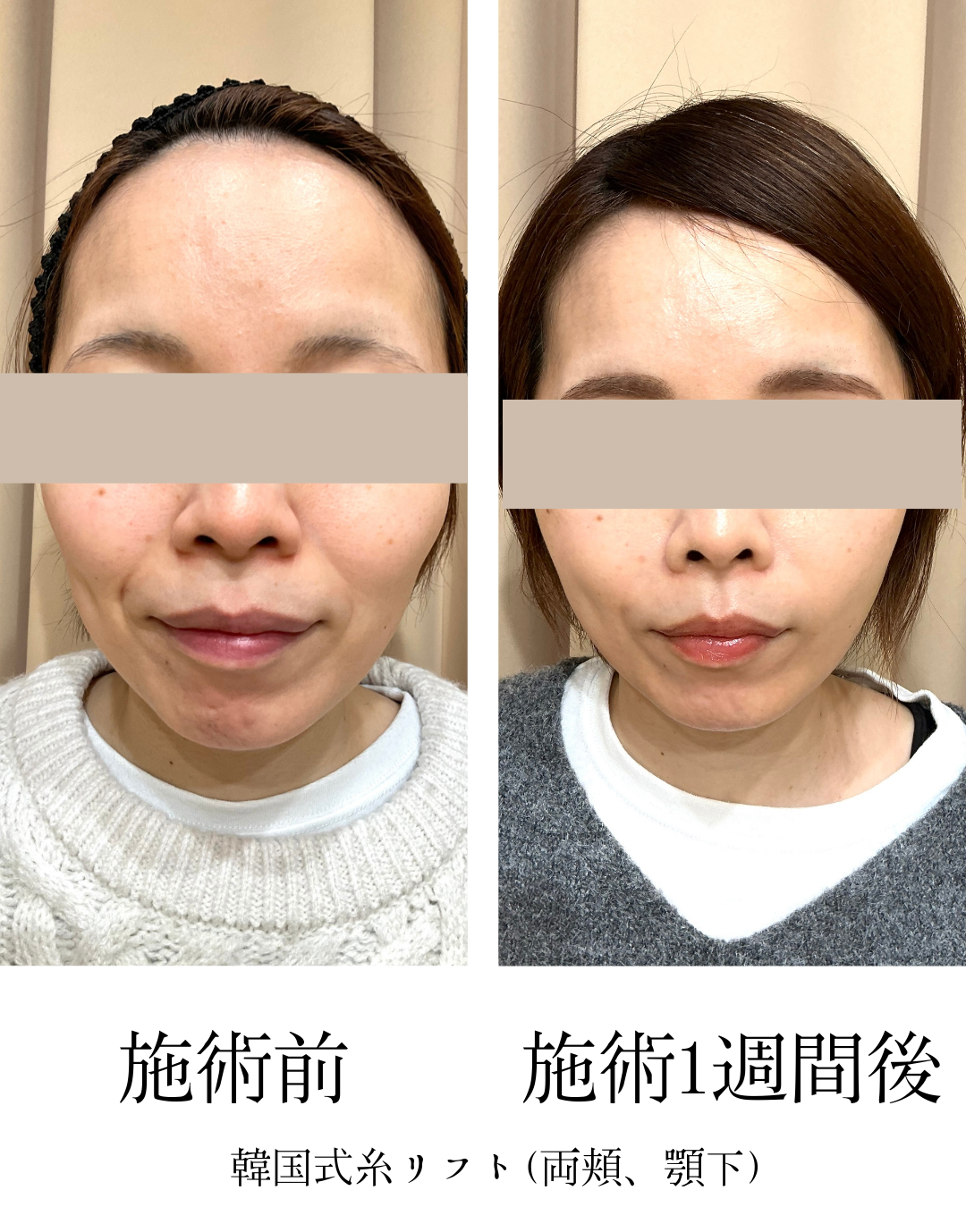 糸リフト（PDO・PCL）：医療用の吸収性糸を皮下に挿入し、たるみを引き上げてフェイスラインを整える施術です。PDOはポリジオキサノン糸、PCLはPDOより分解・吸収がゆっくりなポリカプロラクトン糸を使用します。の症例写真