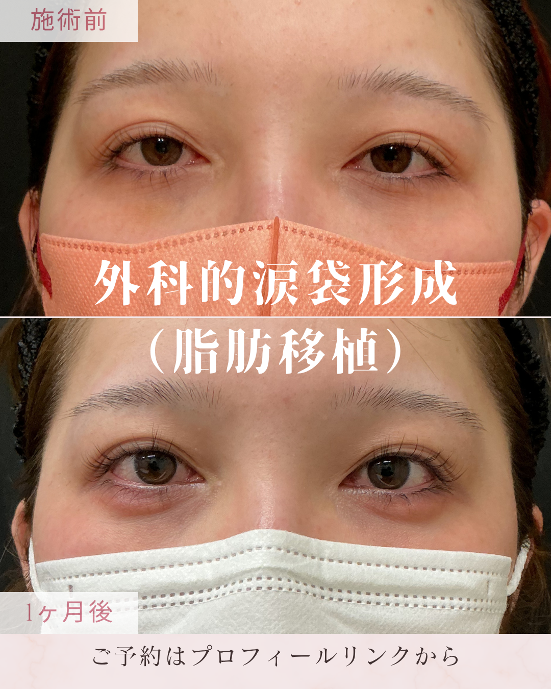 涙袋形成：下まぶたに自然なふくらみをつくり、目元を立体的で華やかな印象に整える施術です。脂肪移植はご自身の脂肪を採取・加工して注入し、埋没法は下まぶたの組織を糸で固定します。ハイブリッド法は脂肪移植と埋没法を組み合わせます。の症例写真