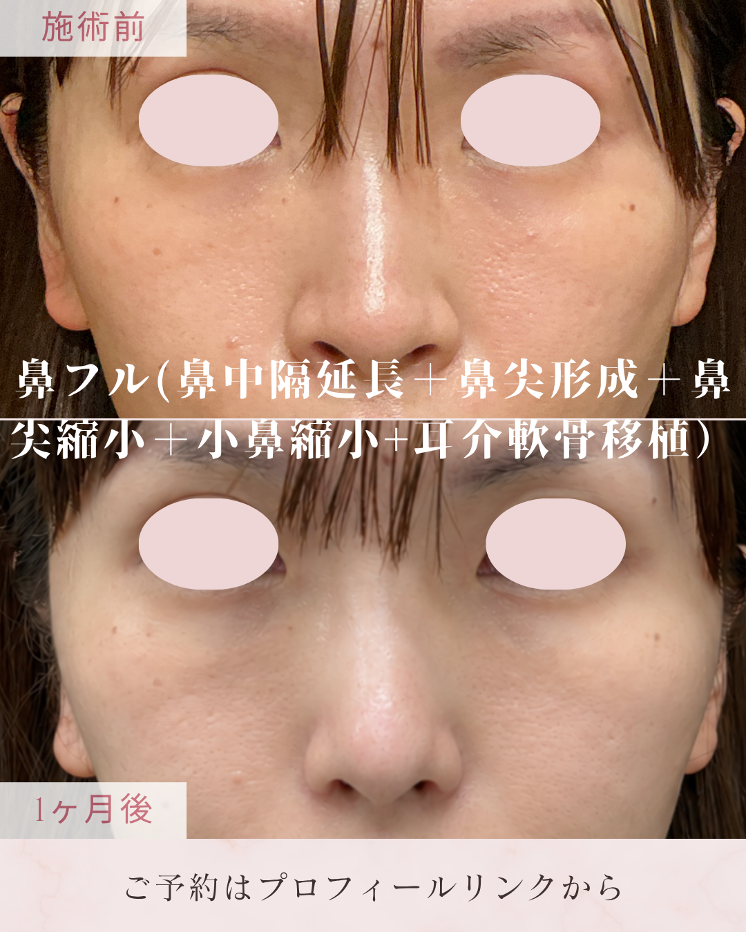 鼻フルコース：鼻中隔延長・鼻尖形成・鼻尖縮小・耳介軟骨移植を組み合わせ、鼻先の形や高さ、鼻全体のバランスを整える施術です。鼻中隔を軟骨などで補強・延長し、鼻先の軟骨や軟部組織を調整します。耳の軟骨を採取して鼻先へ移植します。の症例写真