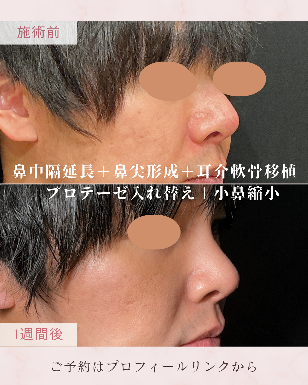 鼻フルコース：鼻中隔延長・鼻尖形成・鼻尖縮小・耳介軟骨移植を組み合わせ、鼻先の形や高さ、鼻全体のバランスを整える施術です。鼻中隔を軟骨などで補強・延長し、鼻先の軟骨や軟部組織を調整します。耳の軟骨を採取して鼻先へ移植します。の症例写真