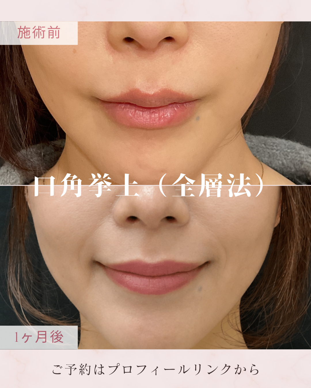 口角挙上術（全層法）：口角を下げている組織を調整し、口角を上方向へ引き上げることで、明るく自然な印象の口元を目指す施術です。全層法では口角周囲の皮膚・筋肉などを含めて処理し、口角の形を整えます。の症例写真