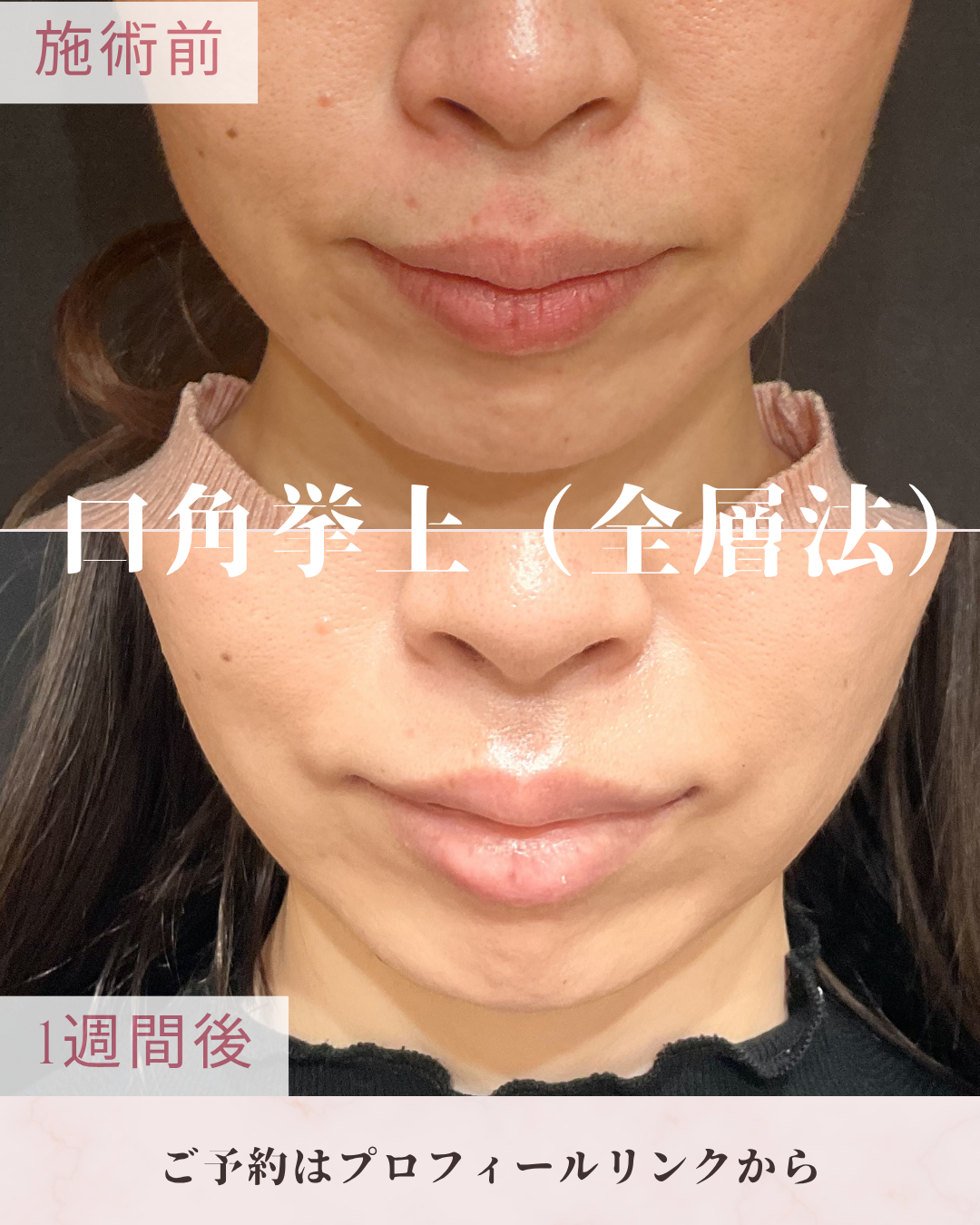 口角挙上術（全層法）：口角を下げている組織を調整し、口角を上方向へ引き上げることで、明るく自然な印象の口元を目指す施術です。全層法では口角周囲の皮膚・筋肉などを含めて処理し、口角の形を整えます。の症例写真