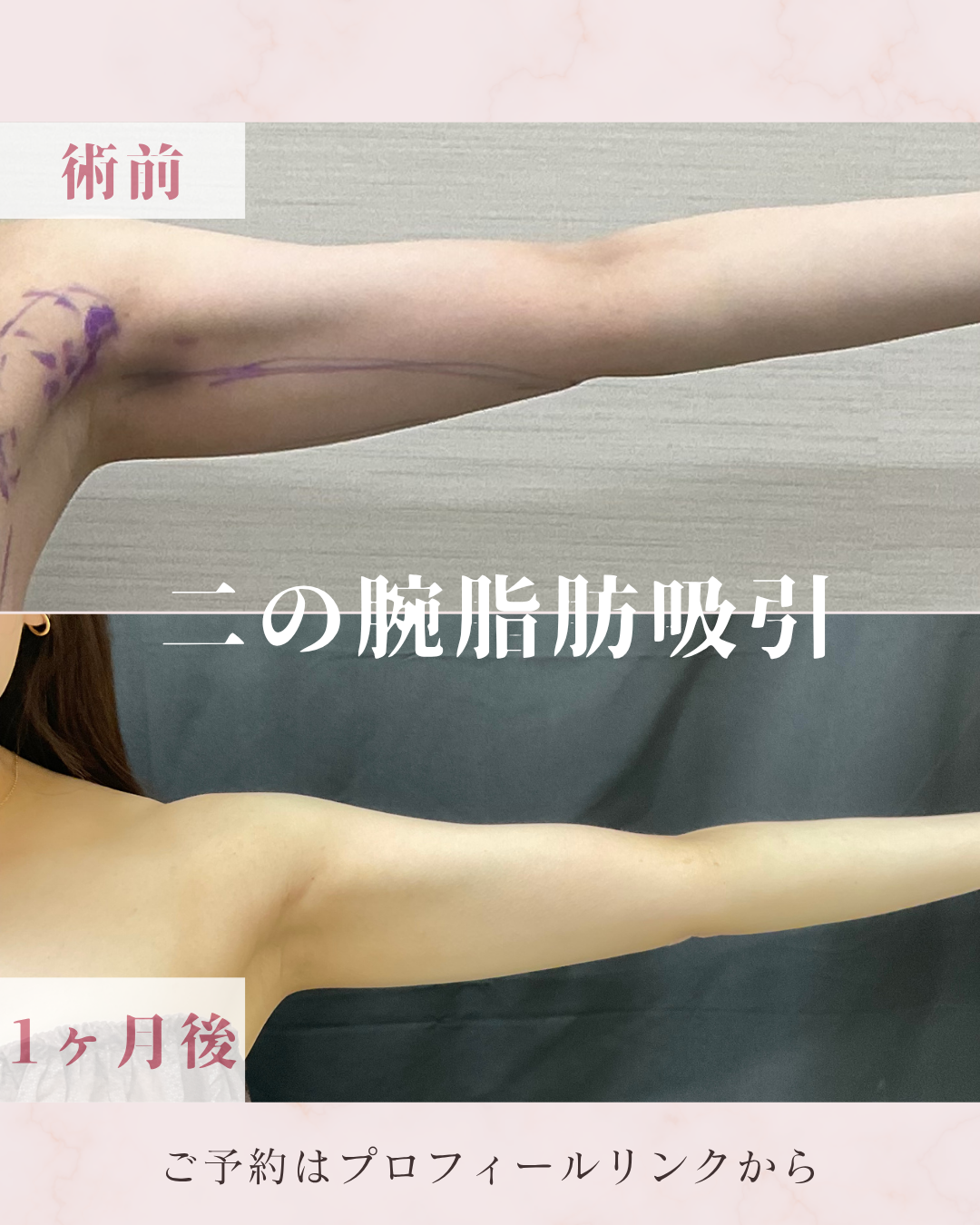脂肪吸引：カニューレと呼ばれる細い管を使用して皮下脂肪を吸引・除去し、ボディラインやフェイスラインを整える施術です。脂肪細胞そのものを減らすことで、部分的なサイズダウンやすっきりとした輪郭を目指します。の症例写真