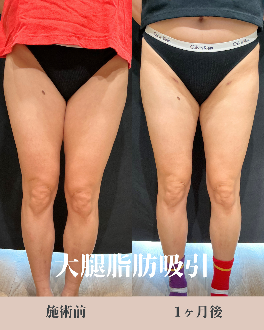 脂肪吸引：カニューレと呼ばれる細い管を使用して皮下脂肪を吸引・除去し、ボディラインやフェイスラインを整える施術です。脂肪細胞そのものを減らすことで、部分的なサイズダウンやすっきりとした輪郭を目指します。の症例写真