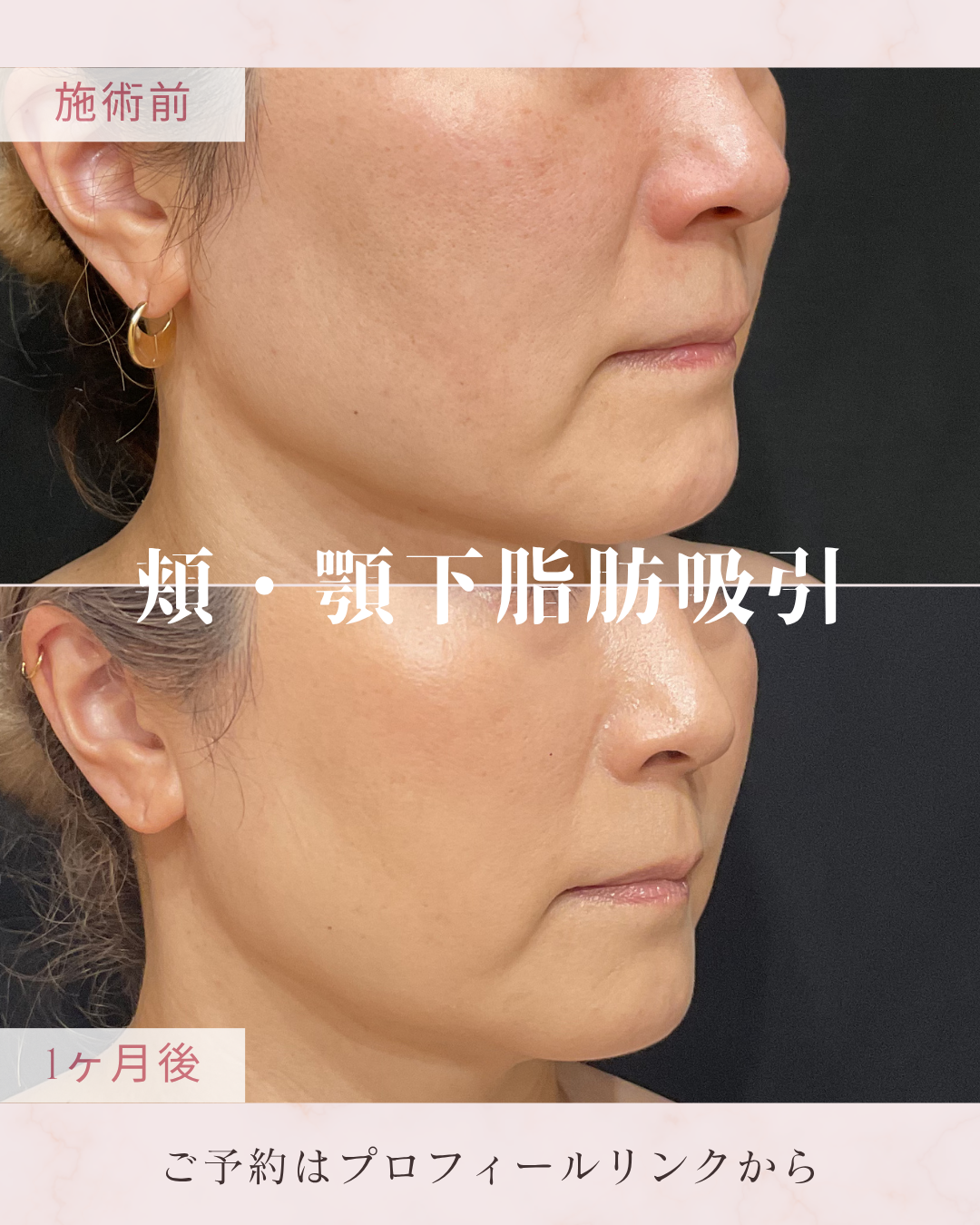 脂肪吸引：カニューレと呼ばれる細い管を使用して皮下脂肪を吸引・除去し、ボディラインやフェイスラインを整える施術です。脂肪細胞そのものを減らすことで、部分的なサイズダウンやすっきりとした輪郭を目指します。の症例写真