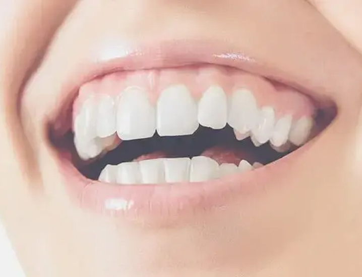 ガミースマイル