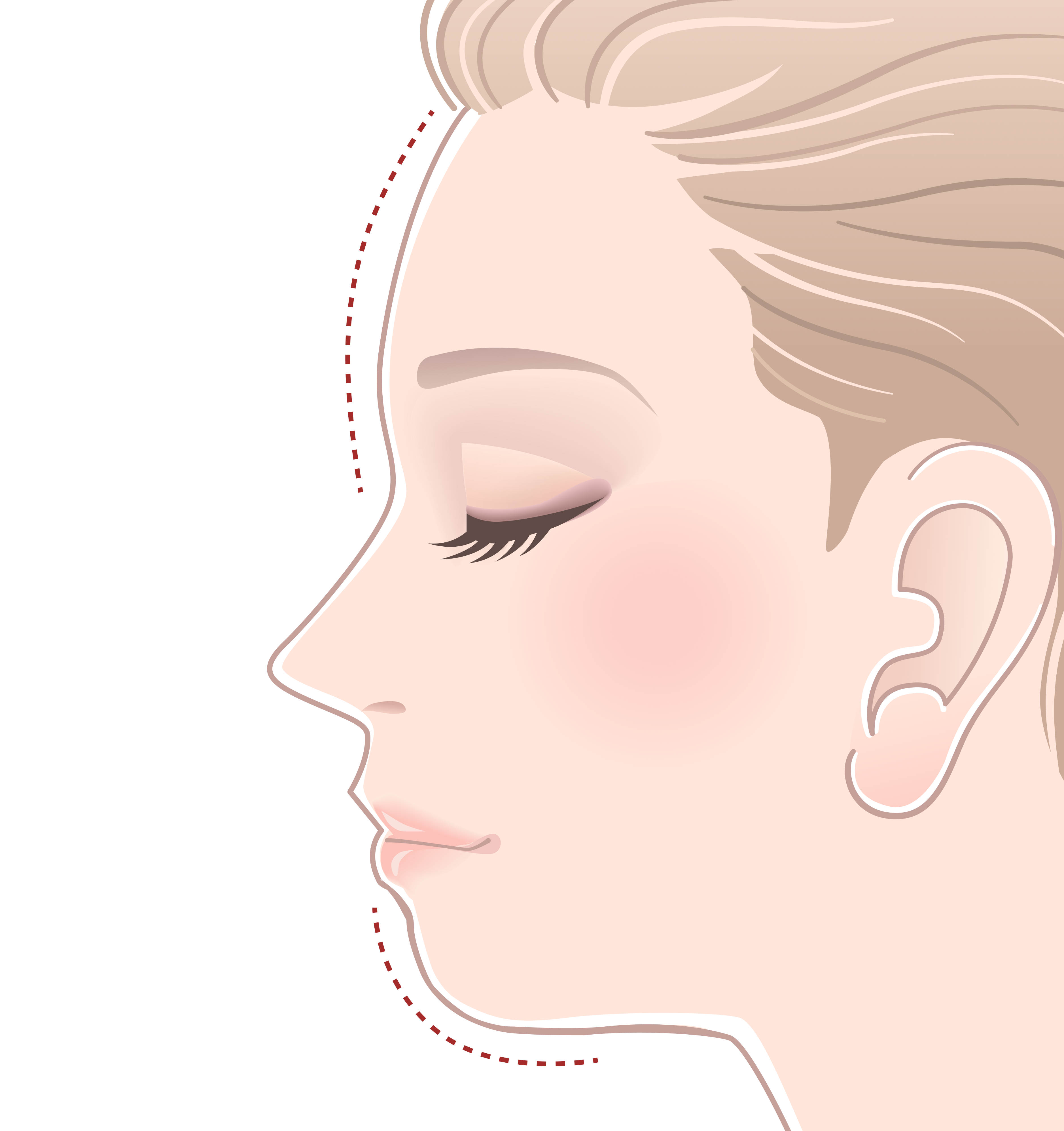 顎・おでこヒアルロン酸注入なし