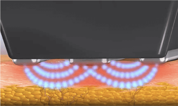 深層からのコラーゲン再生