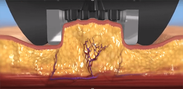 脂肪分解とサイズダウンと即時引き締め効果