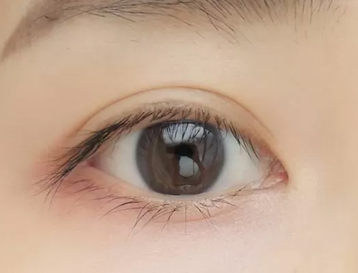 真崎式埋没について