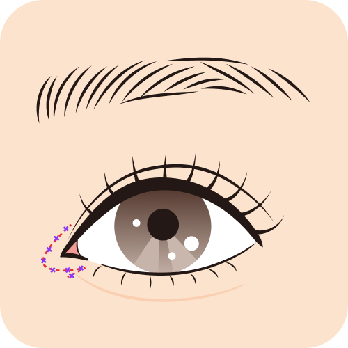 韓流リドレープ法 After