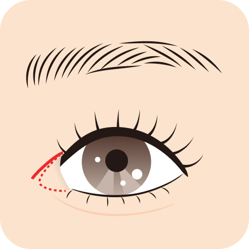 韓流リドレープ法 Before