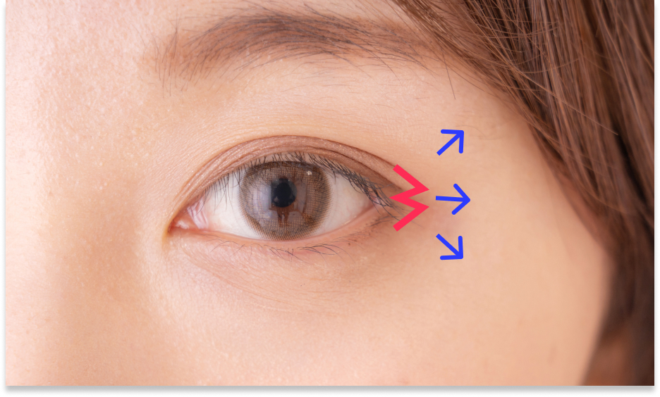 目尻切開（W形成）について