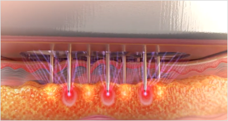 深部まで熱を届ける強力タイトニング