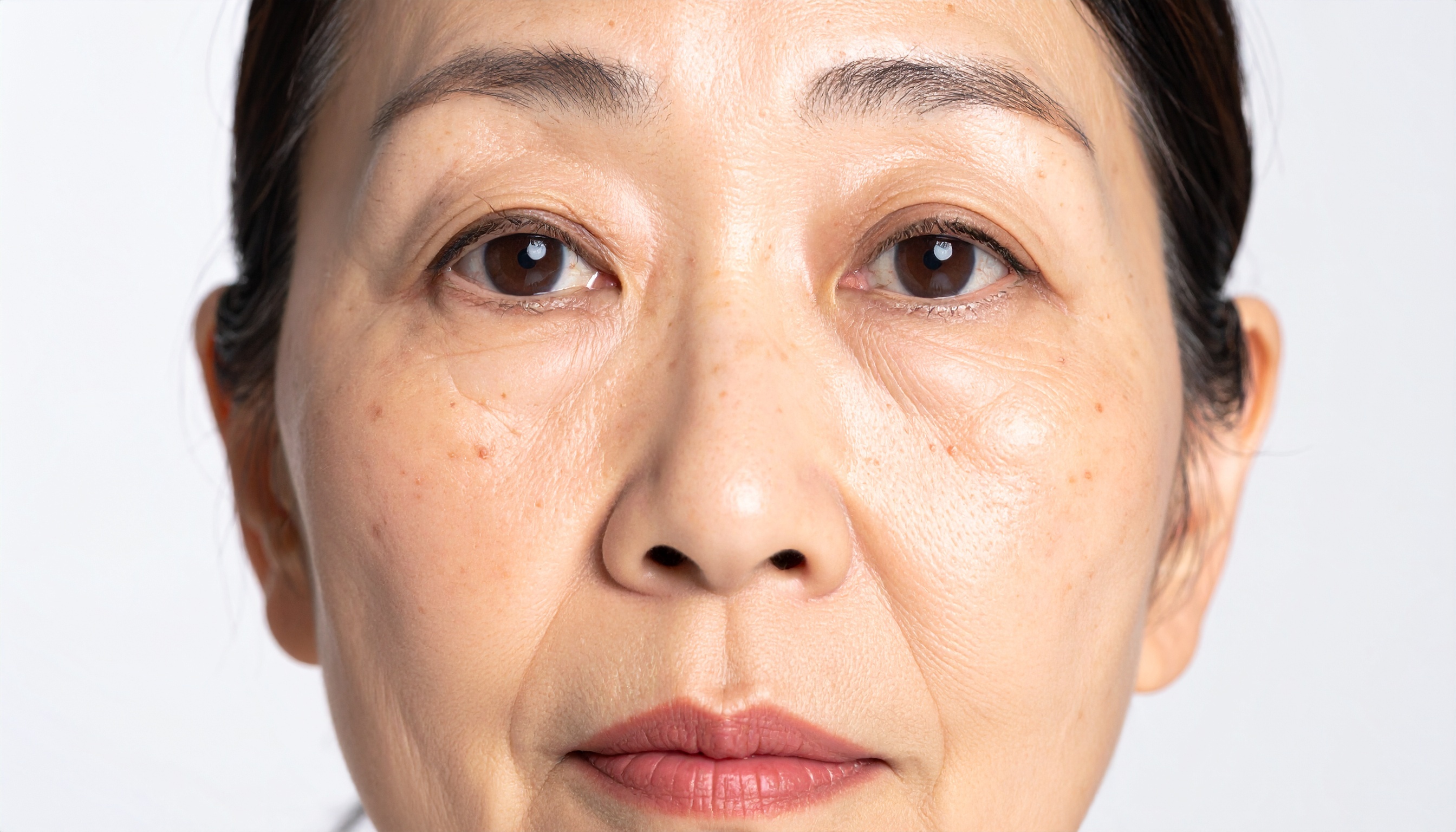 目元のクマ・たるみ改善にも対応