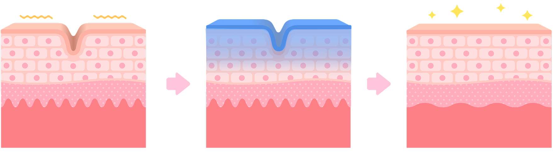 マッサージピール