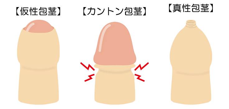 切らない包茎術