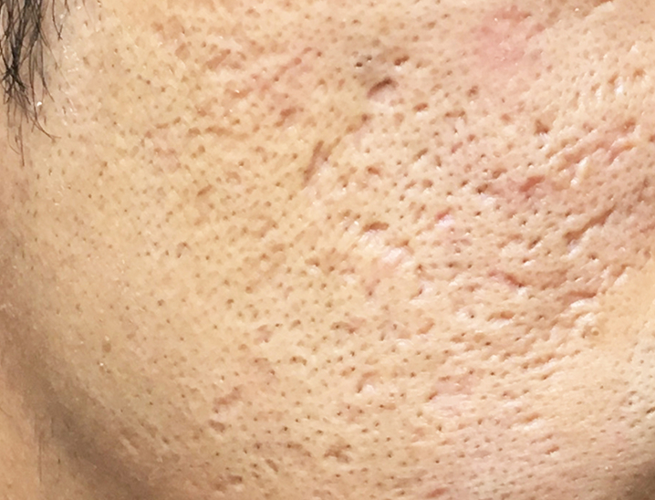 サブシジョンとは