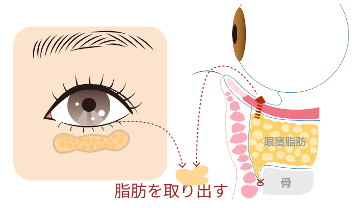 切らないくまとり施術後