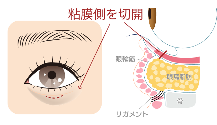 切らないくまとり施術前