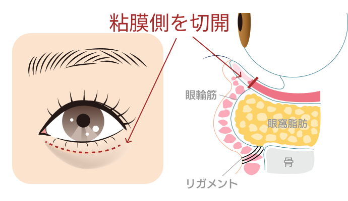 裏ハムラ施術前