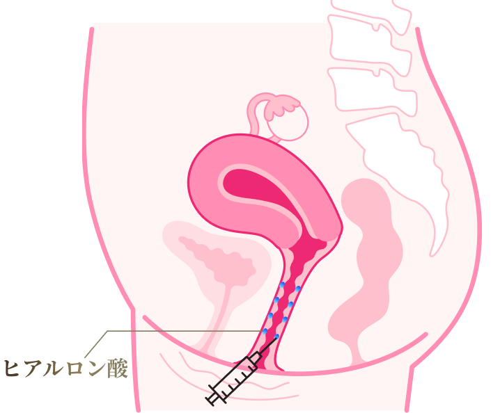 ヒアルロン酸による膣形成について