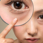 姫路でクマ取りをお考えの方へ｜治療法・費用・ダウンタイムを徹底解説