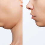 姫路でインモード（INMODE）ならアデル美容クリニック｜小顔・二重顎・脂肪除去を叶える