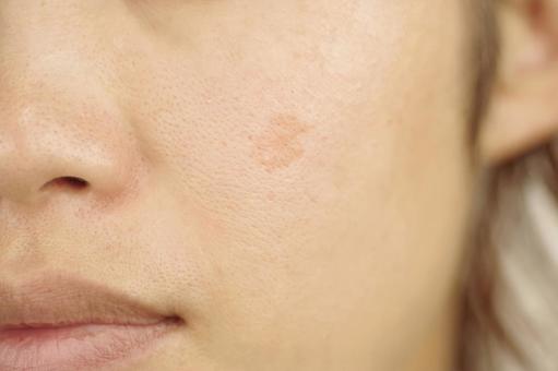 姫路でピコレーザーならアデル美容クリニック｜シミ・そばかす・毛穴悩みを解決